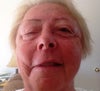 botox caused paralysis 2
