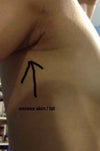 Excess skin on armpits