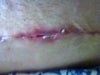 Open Wound