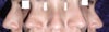 For some reason, the hump is larger on the right side of my nose.