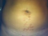 4 days post treatment
