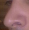 this is what really bothers me. The tip looks extremely large for the new nose. it 's either swollen or didi not get any work ?? It's like the bump was transfered from the top of my nose to the tip. It looks like  a BEAK :((