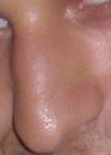 the old nose. with the bump . u cans ee the tip looks the same as post surgery. Despite i was told it was going to be lifted , shortened and refine ?!?!?