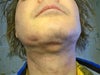 Lumps after neck lift