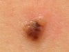 Mole that was removed on 7/31. The pic has been blown up 6x on my iphone.