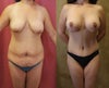 breast lift- mommy make over
