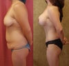 Inverted-t breast lift