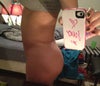 Side view 1 wk post op...