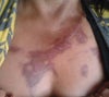 This is the burn mark as of 3 weeks.