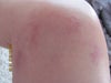 Matting on knee