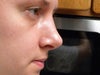 2.5 weeks after rhinoplasty