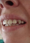 broken veneer on canine
