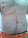 You can see from the scar how it's not straight.