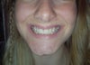 You can see to the left of the picture, my chin is much longer and is bumpy, the otherside is shorter. You can see how off-centre my teeth are.