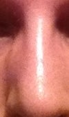 The bump is visible along the right side of my nose