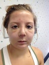 one week post op after splint removed from nose