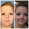 Before surgery and 3 weeks after.