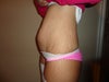 1 day before surgery