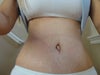 5 weeks post op