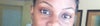 Eye Hollowness