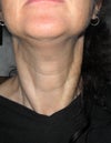 Visible cords, accentuated by clenching