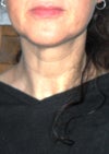 Cords visible even without clenching