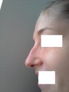 the hump is pretty obvious. i am smiling here and everything kind of droops downwards. u can see the length of my nostrils and how much my nose projects from my face here.