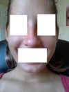 here u can see how bulbous my nose is, it is worse becomes i am smiling forcefully. i feel like there is a lot of cartilage and skin.
the tip doesnt bother me as much as the bump and projection does though.