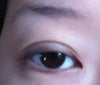 Extra fold on right eye
