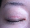 Will the scar get better? It is raised and pink