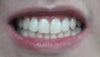 After the bridge, when my teeth just come together and I hold them