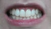 When I occlude all the way. Note the crooked midline and reduced opening in my upper first premolar compared to the first picture.