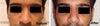 Front views, notice the exposed nostrils/lifted tip, and loss of that nice curve at the bottom