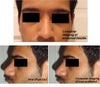 My preferred results, the front view imaging has always been the same, i have done a new imaging for the side view to something more realistic, as i have read that tip lengthening & de-rotation is more limited.