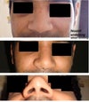 Excessive nostril widening when smiling
