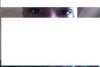 I have a droopy eyelid on my right eye and