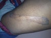 Leg Keloid