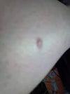 This is what it looks like normally. Just a hard bump, this one on my leg
