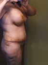 10 day post op extended tummy tuck