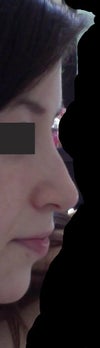 The left side (trouble spot), small bump still noticeable. This makes a big difference in my opinion.