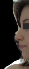 As you can see, my nose and chin do not balance each other out well and my upper lip looks shapeless and flat.