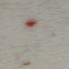Inflammed mole.