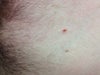 Another post-inflammed mole on the top.
