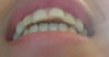 Overbite