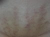 3rd day, red strips, some turned dark brown, some bumpy spots