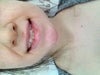 Smiling with teeth, still no shape to my upper lip.