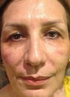 Immediately after treatment