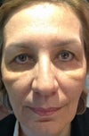 5 days after treatment