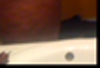 Before Smart Lipo Outer Thighs and Hips