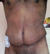 1 month post-op